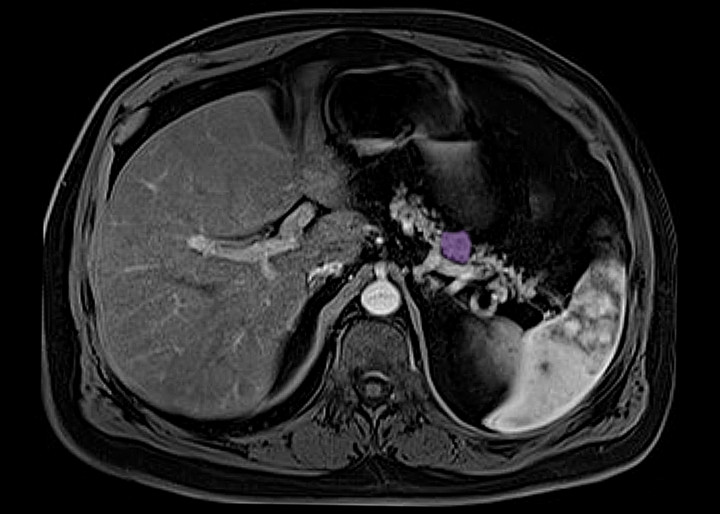 Endokriner Tumor  1500x1070