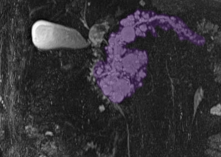 Zystischer Tumor 1500x1070 1