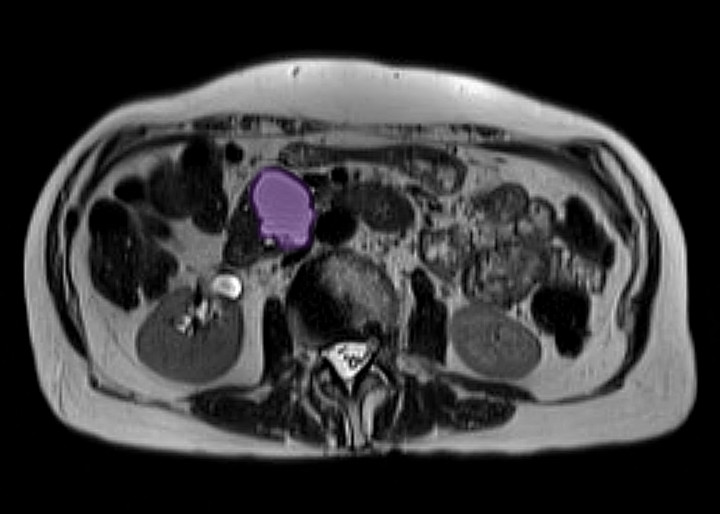 Zystischer Tumor 1500x1070 2